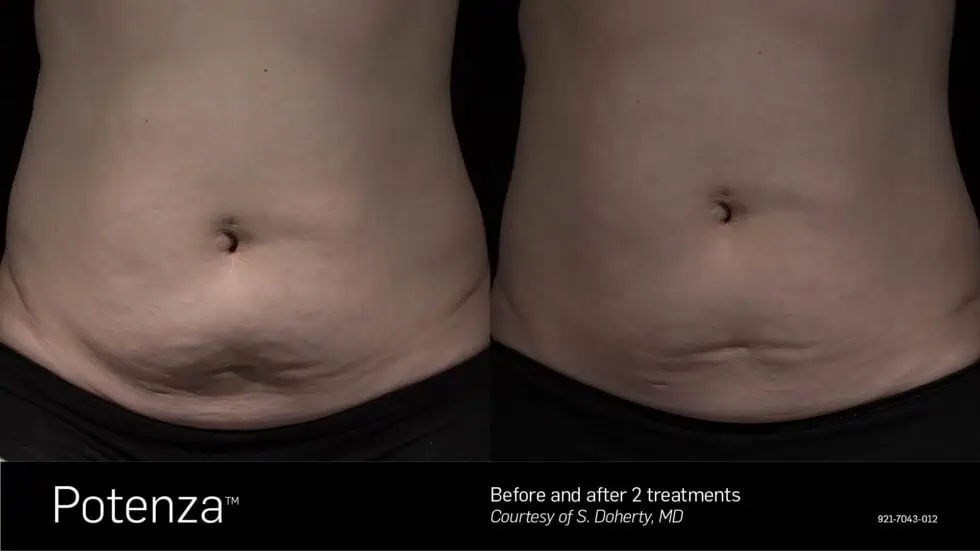 Rf microneedling on the body in Geneva, IL