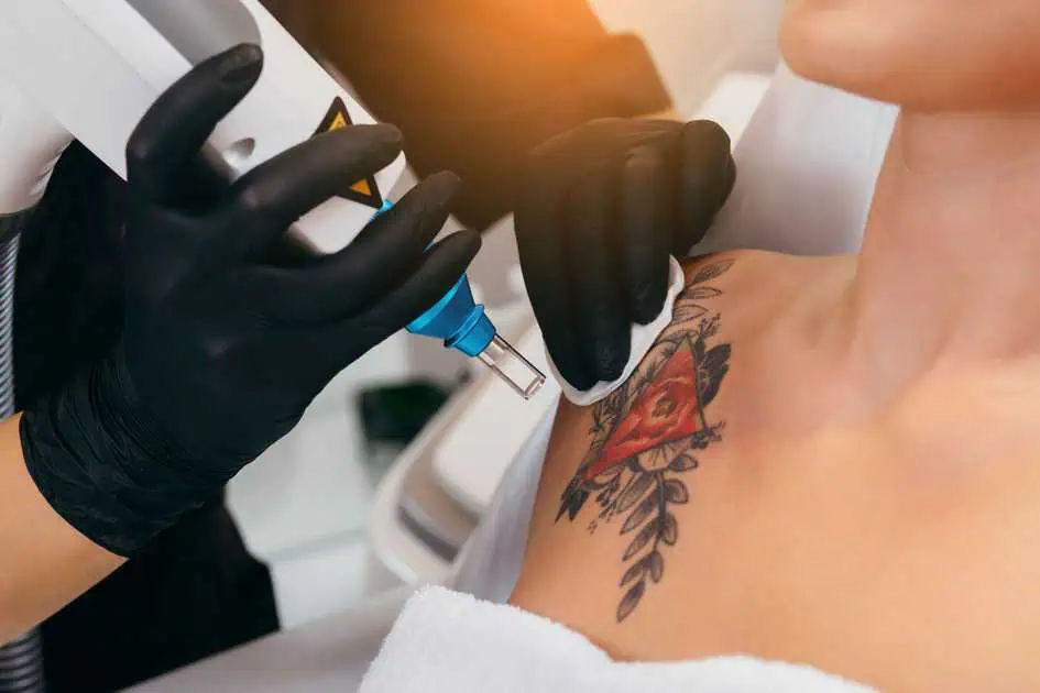 Laser Tattoo Removal in Geneva, IL