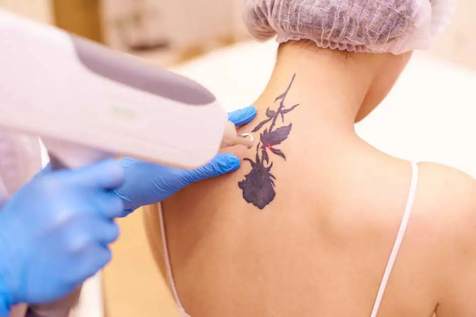 PicoSure® Pro for Tattoo Removal in Geneva, IL